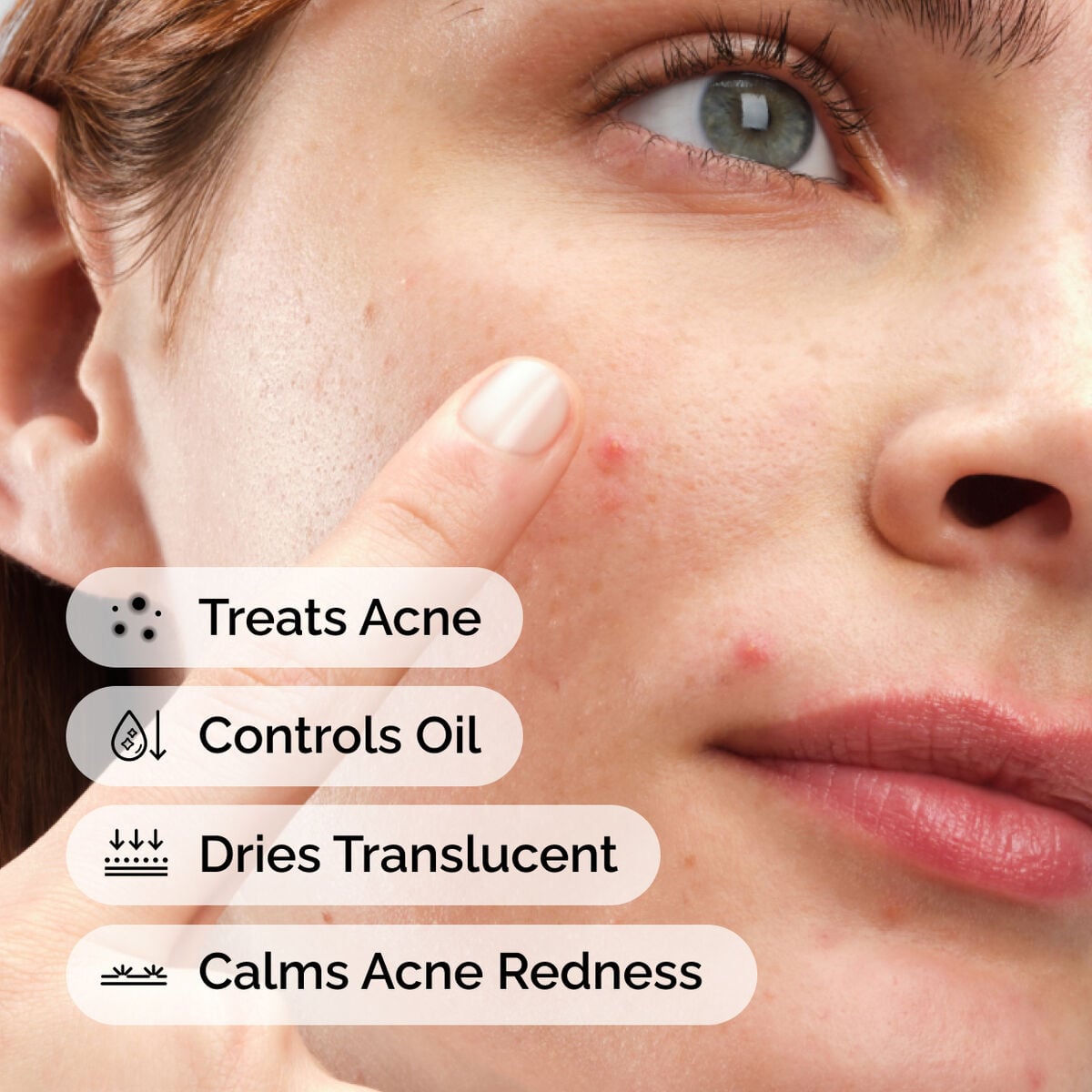 sulfur-10-powder-to-cream-concentrate-t3 ord-sulfur-10pct-powder-to-cream-concentrate-model-application-with-benefits-acne.jpg