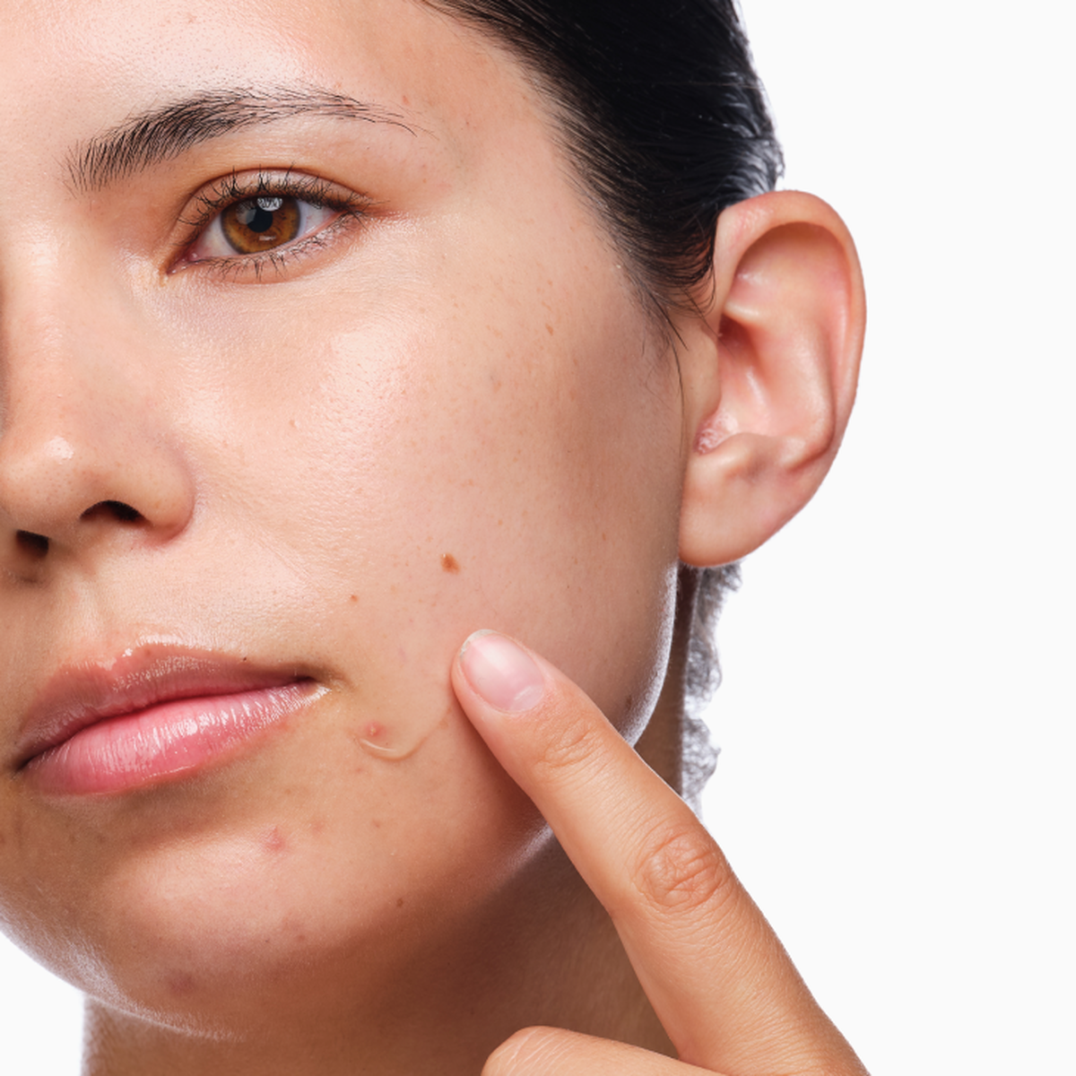 the-acne-set-v3 rdn-the-acne-set-application.png